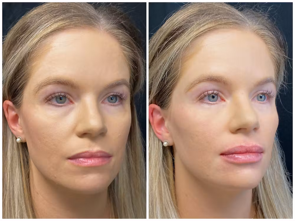 Dermal Fillers