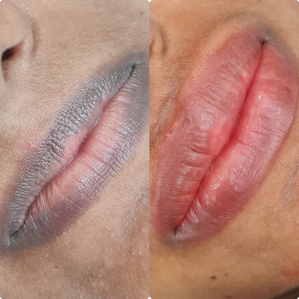Dark Lips Treatment in Wakad