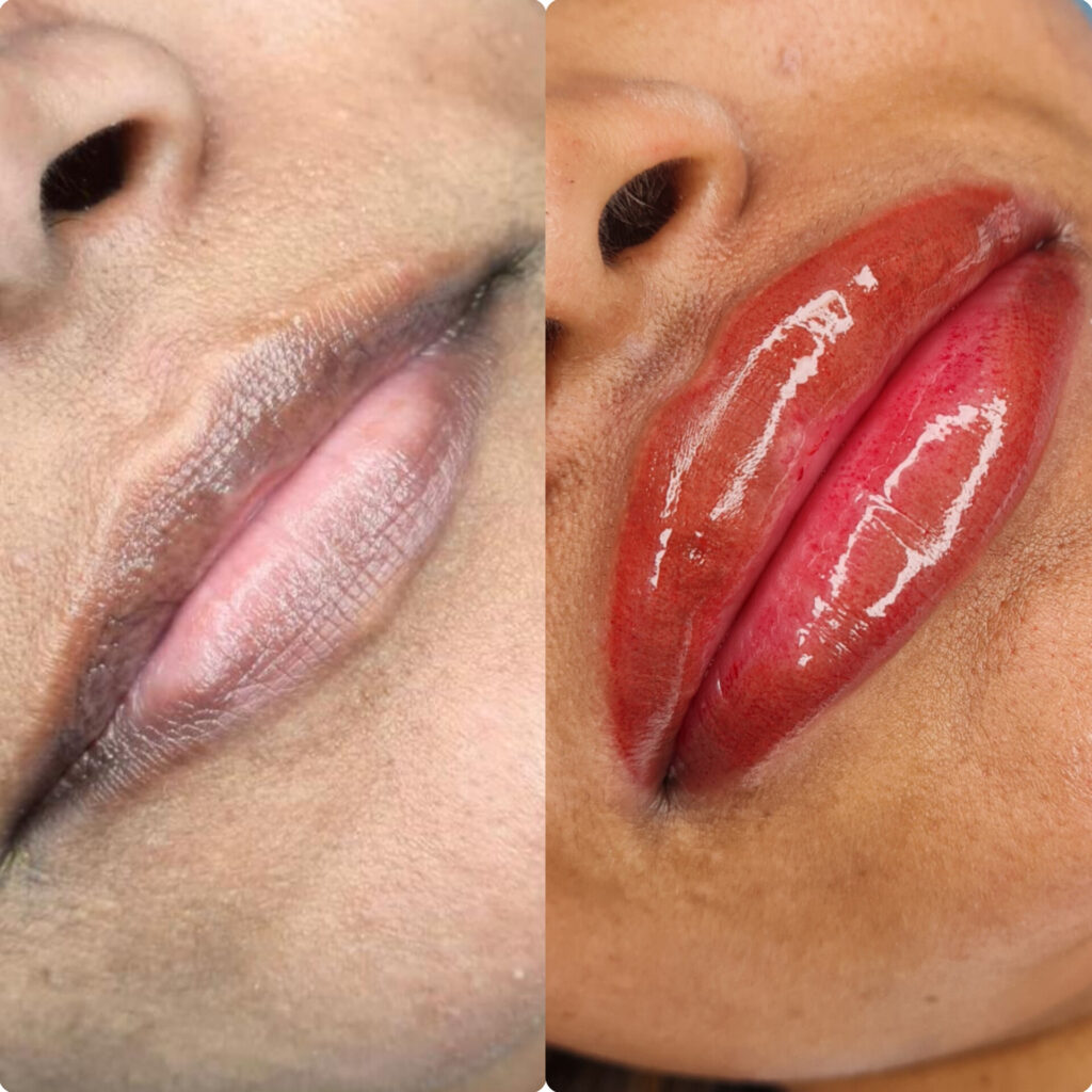 lip pigmentation treatment