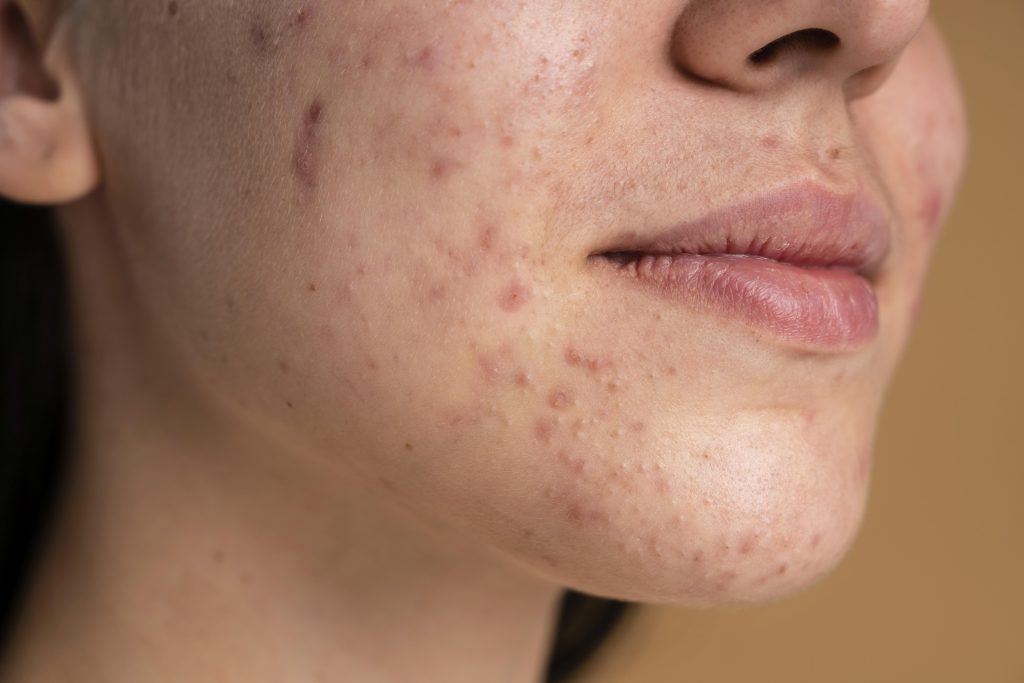 Acne Scar Treatment