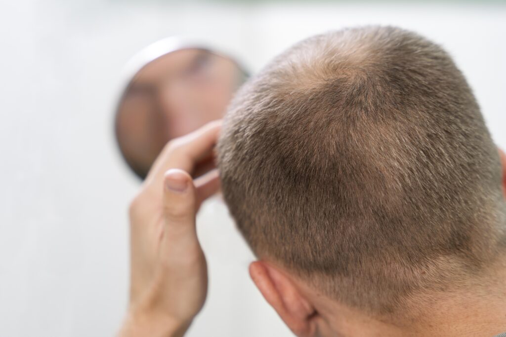 Scarring alopecia treatment in Wakad