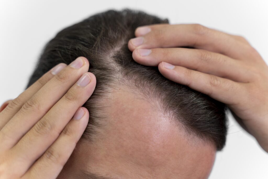 hair transplant in Wakad