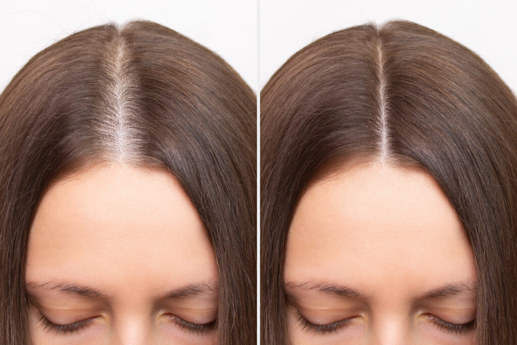 Derma Rollers for Hair Growth