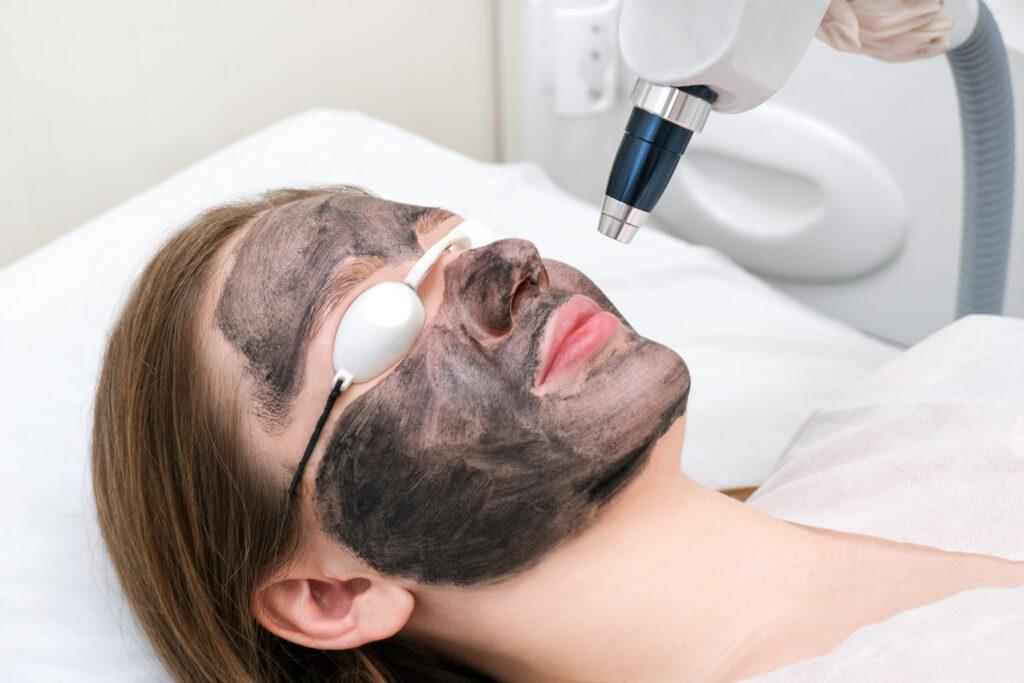 Carbon Laser Facial