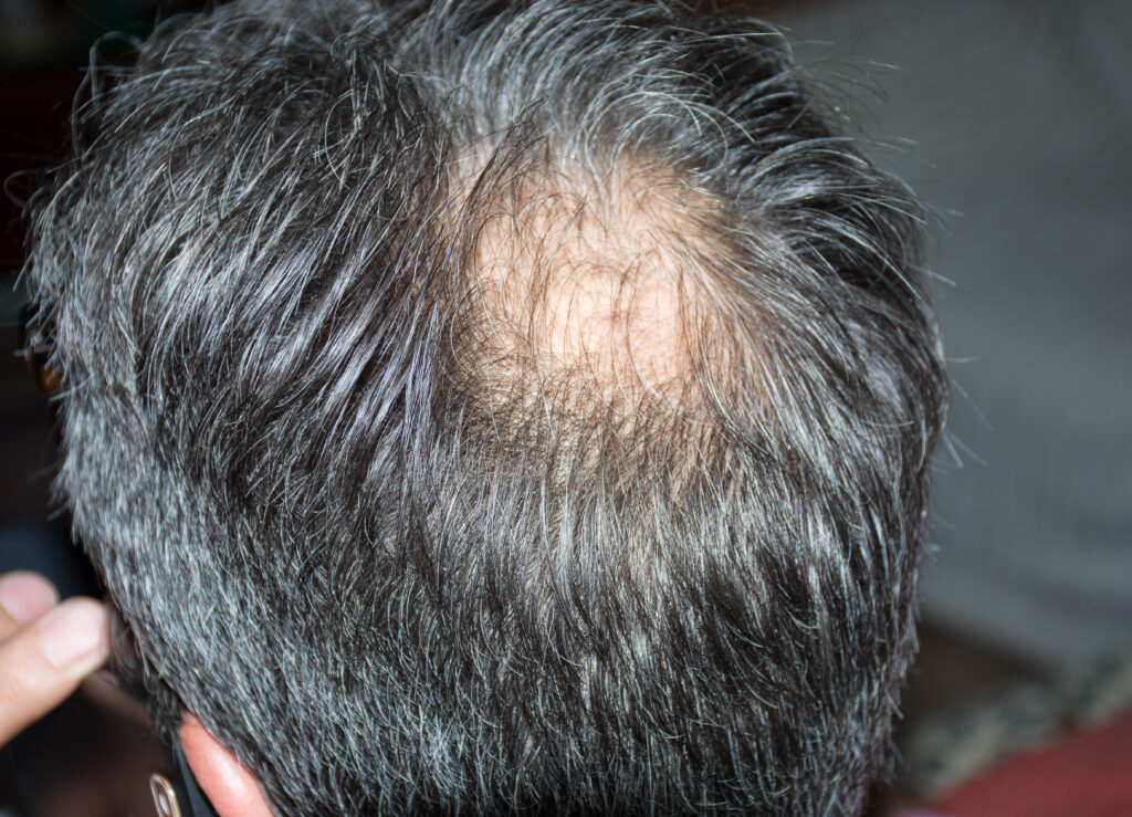 Anagen Effluvium Treatment