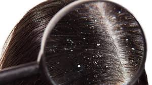 dandruff treatment near me in wakad
