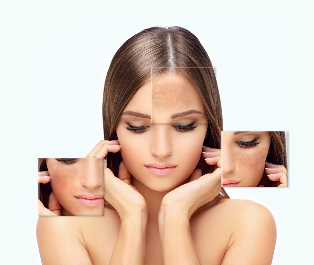 Best melasma clinic Wakad
