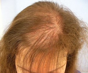 Hair loss treatment in wakad