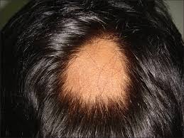 Bald treatments in wakad