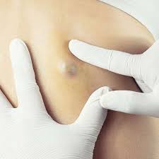 Skin specialist in Wakad Pune