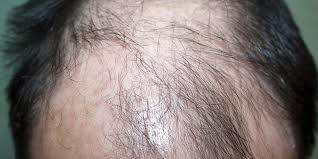 Anagen Effluvium Treatment