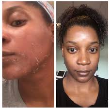 Chemical Peel Treatment in wakad