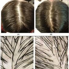 Telogen Effluvium Treatment in wakad