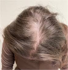 Women hair loss treatment