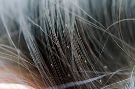 Head Lice Treatment in Wakad