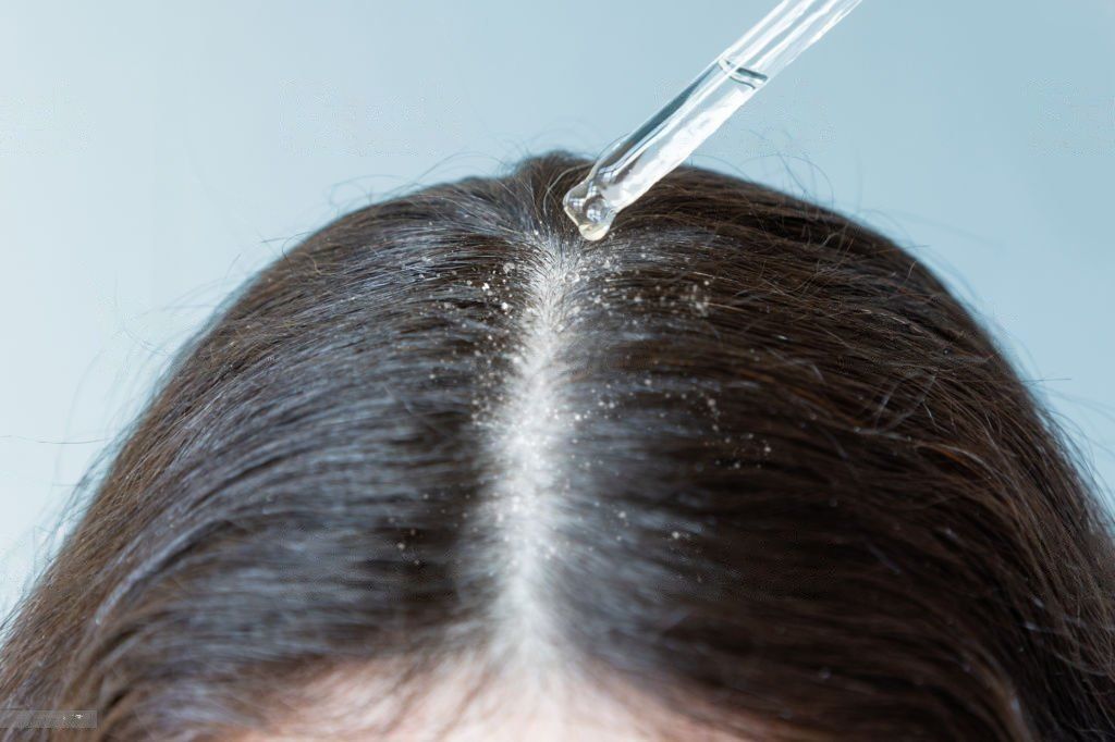 Dandruff Treatment in Wakad