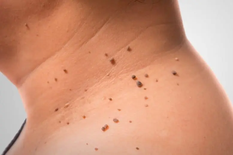 moles removal treatment in wakad