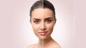 Photofacial Treatment in Wakad