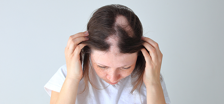 Scarring Alopecia Treatment