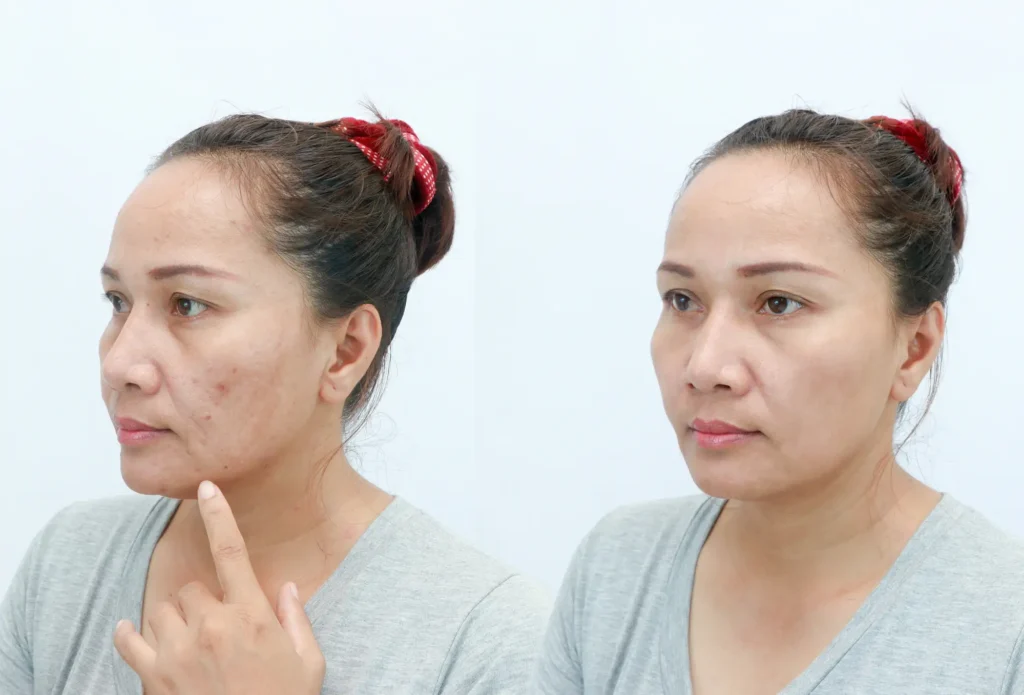 micro needling treatment in Wakad at Regain Clinic.