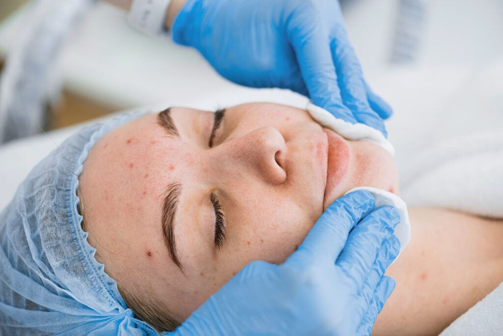 Acne Treatment