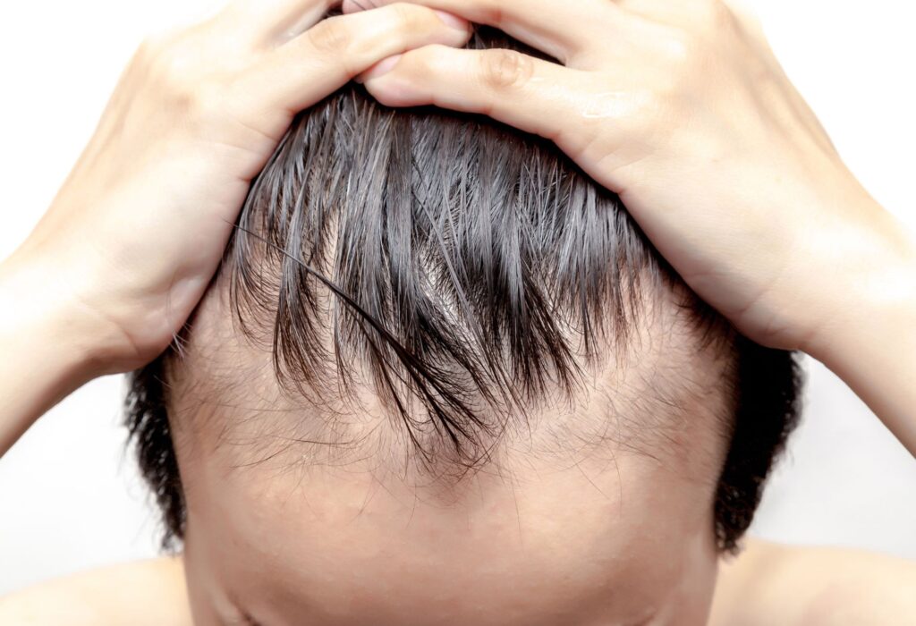 Anagen Effluvium Treatment in Wakad