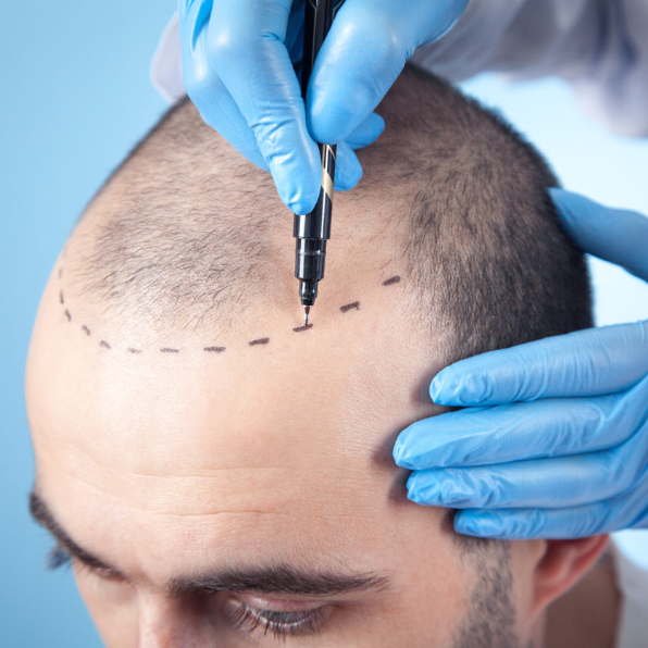 Hair Transplant Treatment in Wakad