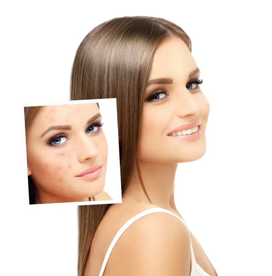 Skin treatment